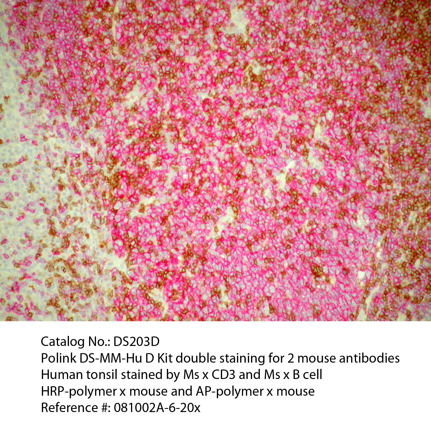 IHC staining of FFPE human tonsil tissue within normal limits using mouse anti-B cell and mouse anti-CD3 polyclonal antibodies and Polink DS-MM-Hu A detection kit [DS203A-18]. The red and brown stain indicate positive stain and blue is the counter stain. It is mounted using a permanent aqueous mounting medium [E03-18].