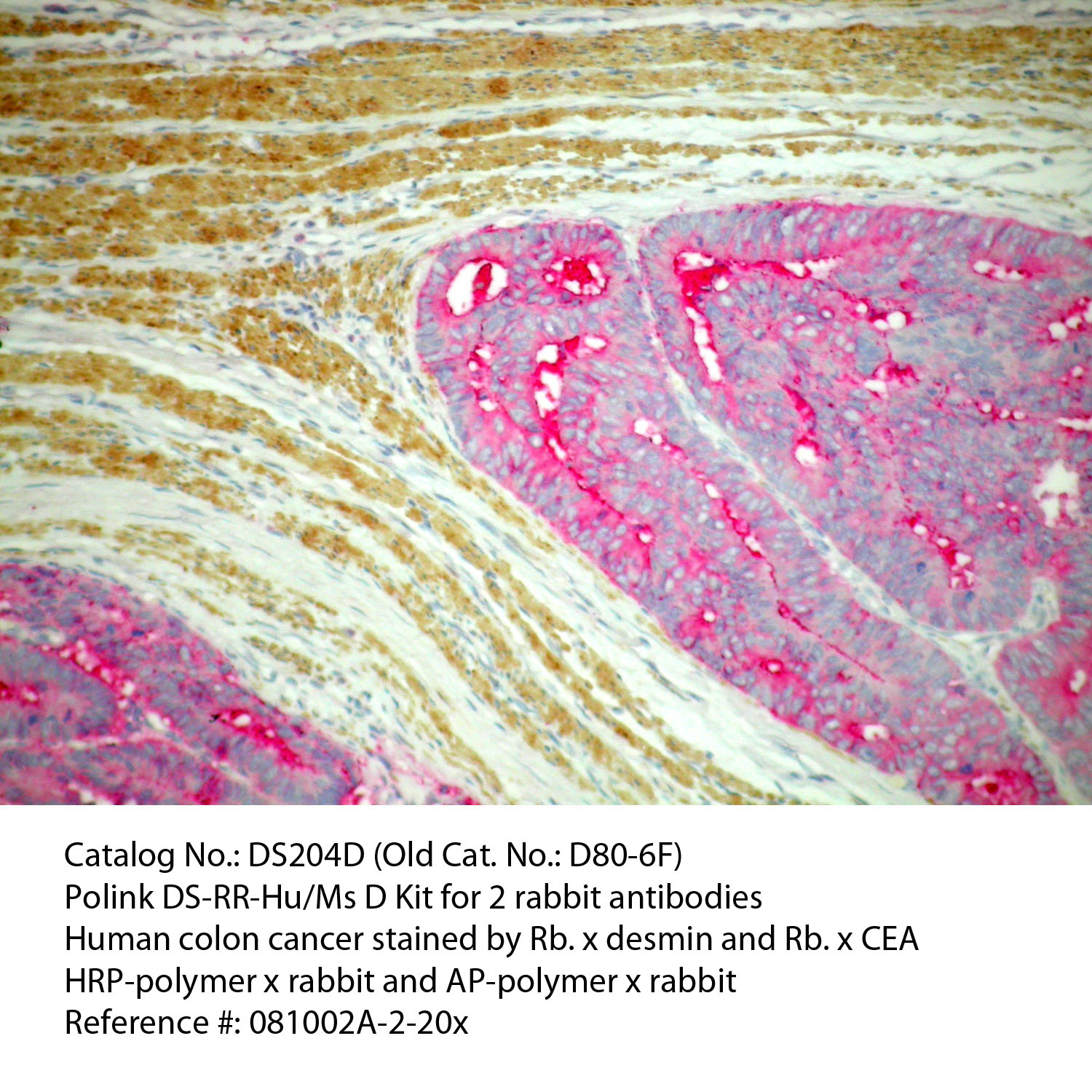 IHC staining of FFPE human colon cancer tissue using rabbit anti-desmin and rabbit anti-CEA polyclonal antibodies and Polink DS-RR-Hu/Ms A detection kit [DS204A-18]. The red (Mouse anti-B cell) and brown (Rabbit anti-CD3) stain indicate positive stain and blue background is the counter stain. It is mounted using a permanent aqueous mounting medium [E03-18].