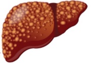 Liver Cirrhosi image