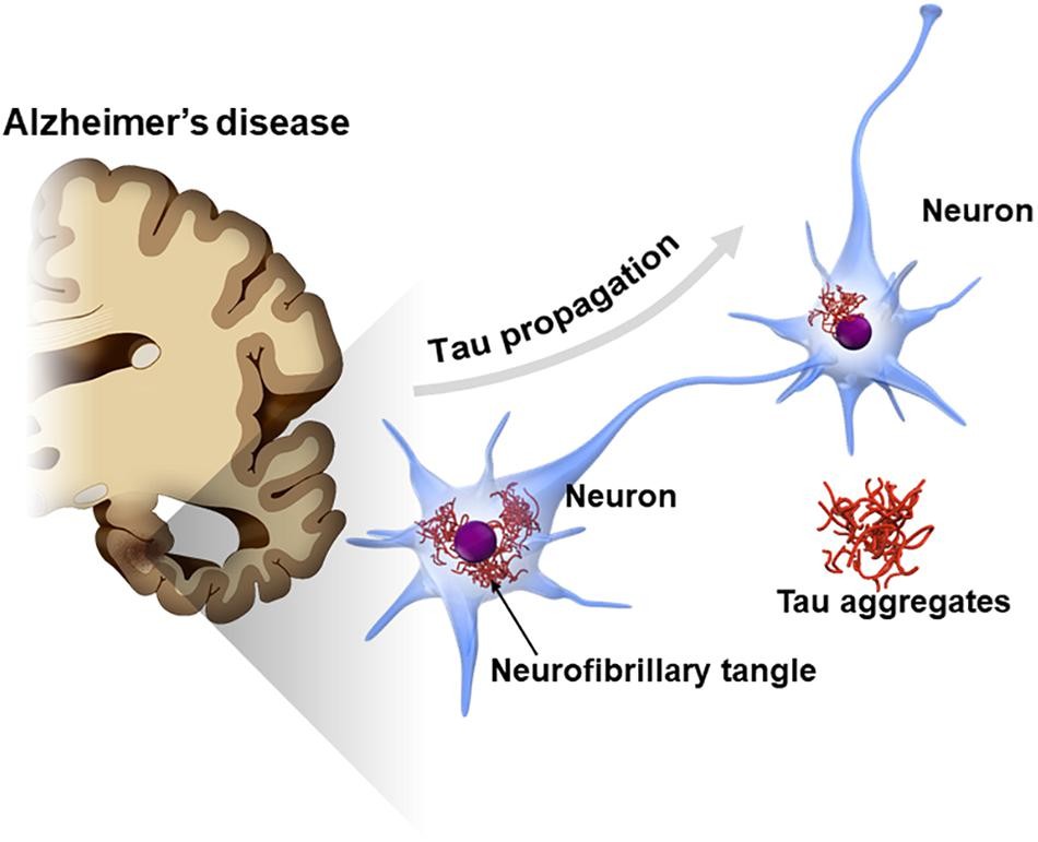 raumatic Brain Injury