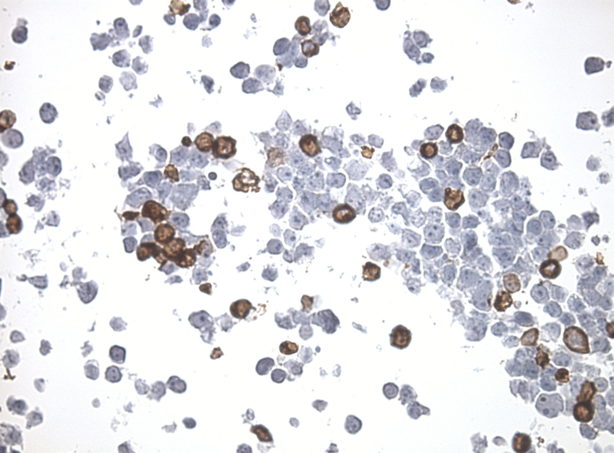 Immunohistology staining on SNRNP40 overexpressed cytosection TS400548P5 with mouse anti DDK clone OTI11C3 C/N TA180144 at 1:400 dilution 4C O/N. Antibody staining was achieved with HIER Citrate pH6 , Polink1 with DAB chromogen detection kit (D11-18). Positive stain shown with the brown chromogen present. HEK293T cells were transfected with cDNA clone RC200548, 5 micron sections, 40x magnification
