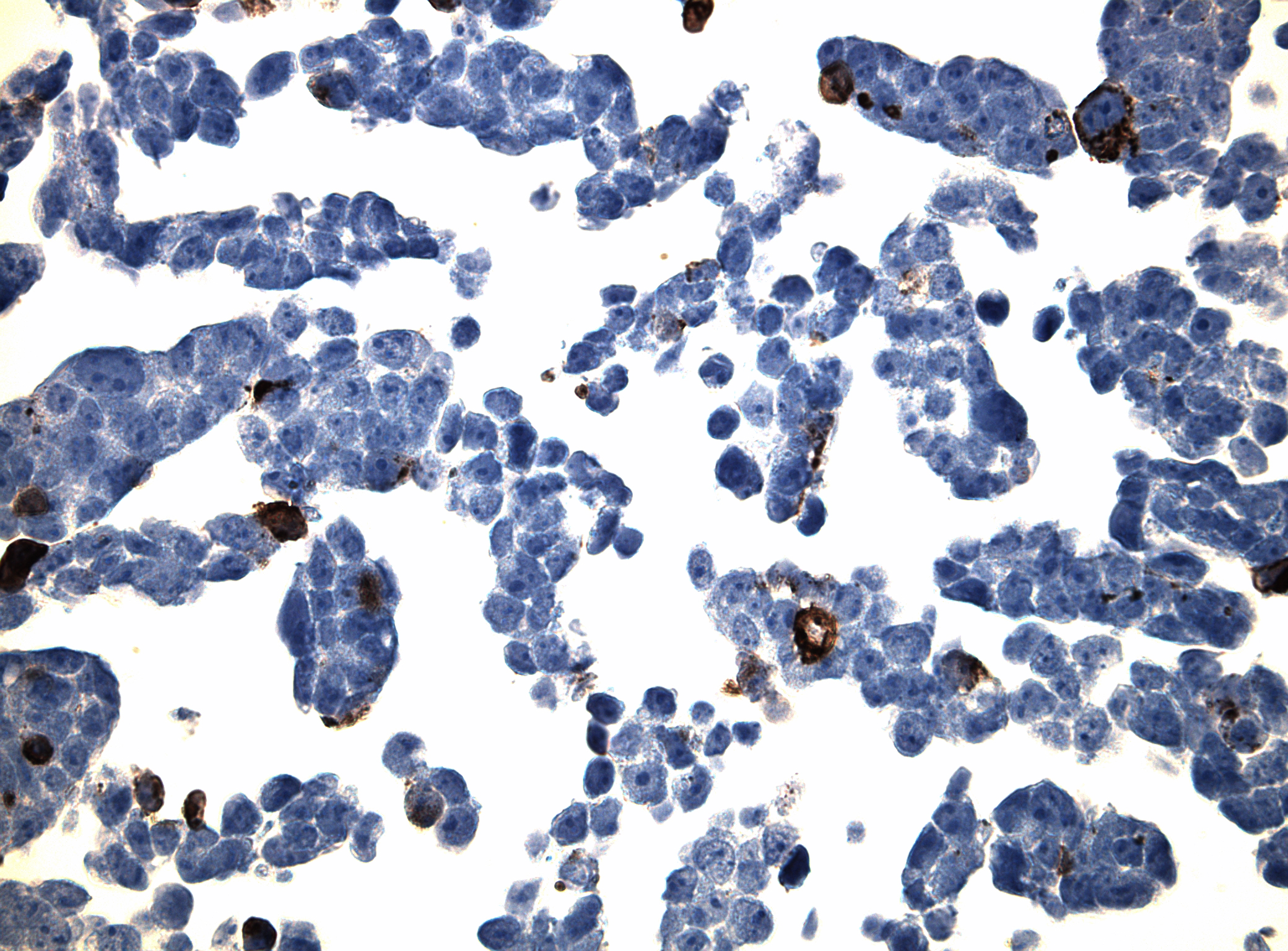 Immunohistology staining on CLDN20 overexpressed cytosection TS405032P5 with rabbit anti DDK clone OTIR5G2 C/N TA592569 at 1:2000 dilution 20m RT. Antibody staining was achieved with HIER Citrate pH6 , Polink1 with DAB chromogen detection kit (D11-18). Positive stain shown with the brown chromogen present. HEK293T cells were transfected with cDNA clone RC205032, 5 micron sections, 40x magnification