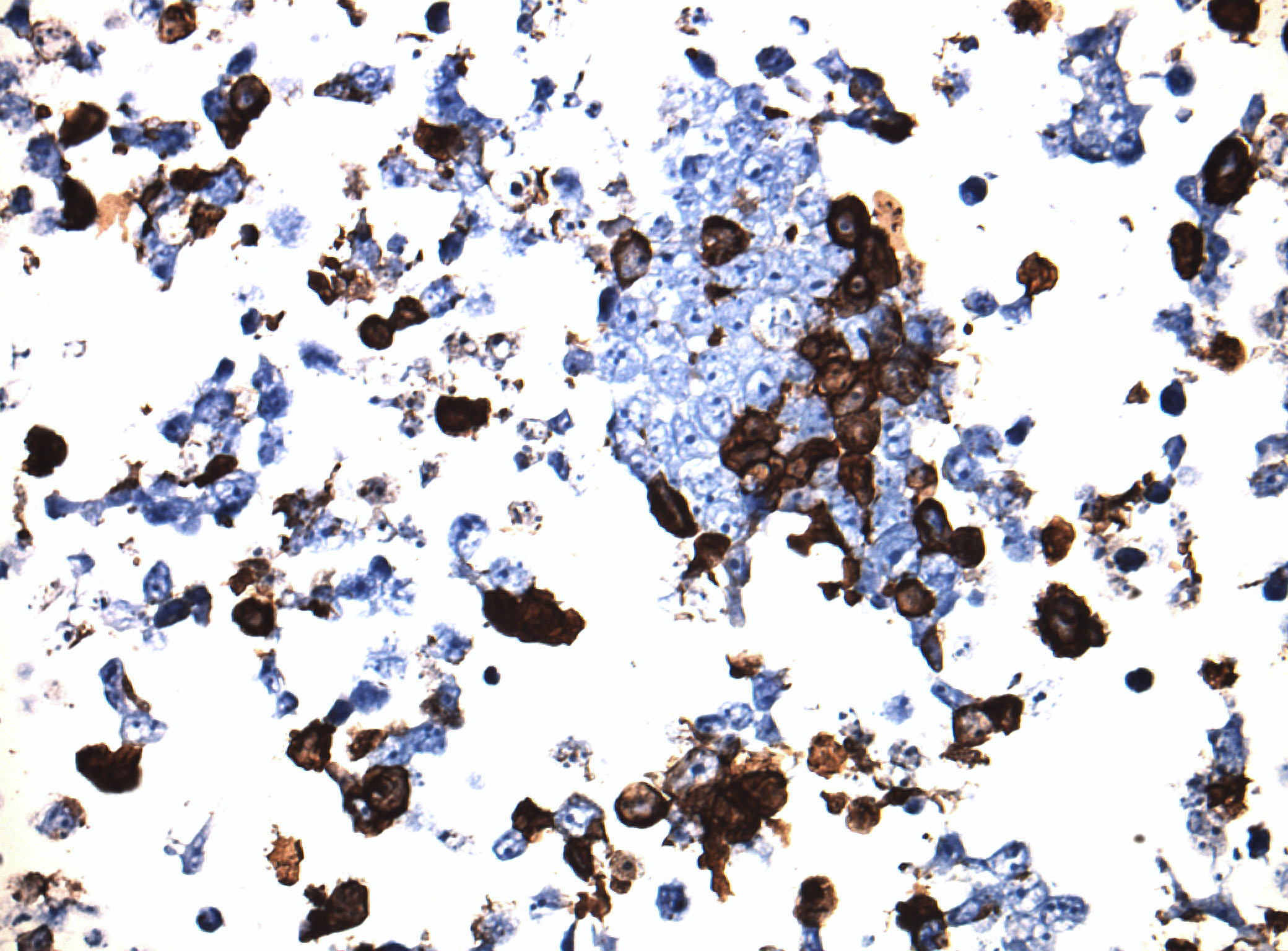Immunohistology staining on AFAP1L2 overexpressed cytosection TS407706P5 with mouse anti DDK clone OTI11C3 C/N TA180144 at 1:400 dilution 4C O/N. Antibody staining was achieved with HIER Citrate pH6 , Polink1 with DAB chromogen detection kit (D11-18). Positive stain shown with the brown chromogen present. HEK293T cells were transfected with cDNA clone RC207706, 5 micron sections, 40x magnification