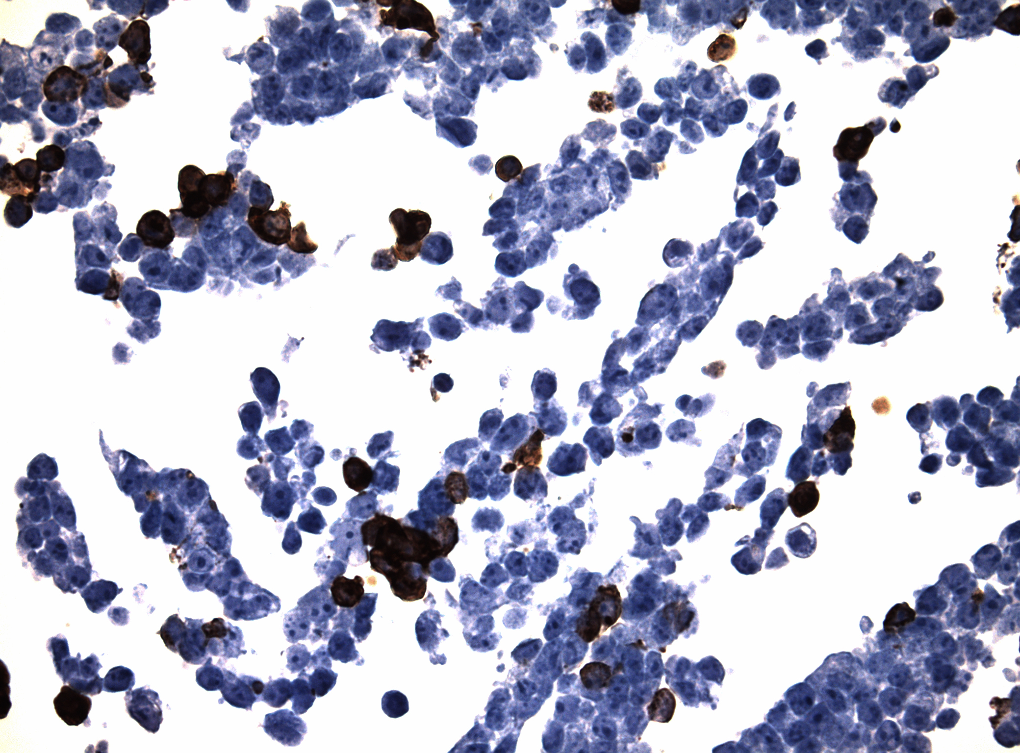 Immunohistology staining on CDH12 overexpressed cytosection TS408156P5 with mouse anti DDK clone OTI11C3 C/N TA180144 at 1:400 dilution 4C O/N. Antibody staining was achieved with HIER Citrate pH6 , Polink1 with DAB chromogen detection kit (D11-18). Positive stain shown with the brown chromogen present. HEK293T cells were transfected with cDNA clone RC408156, 5 micron sections, 40x magnification