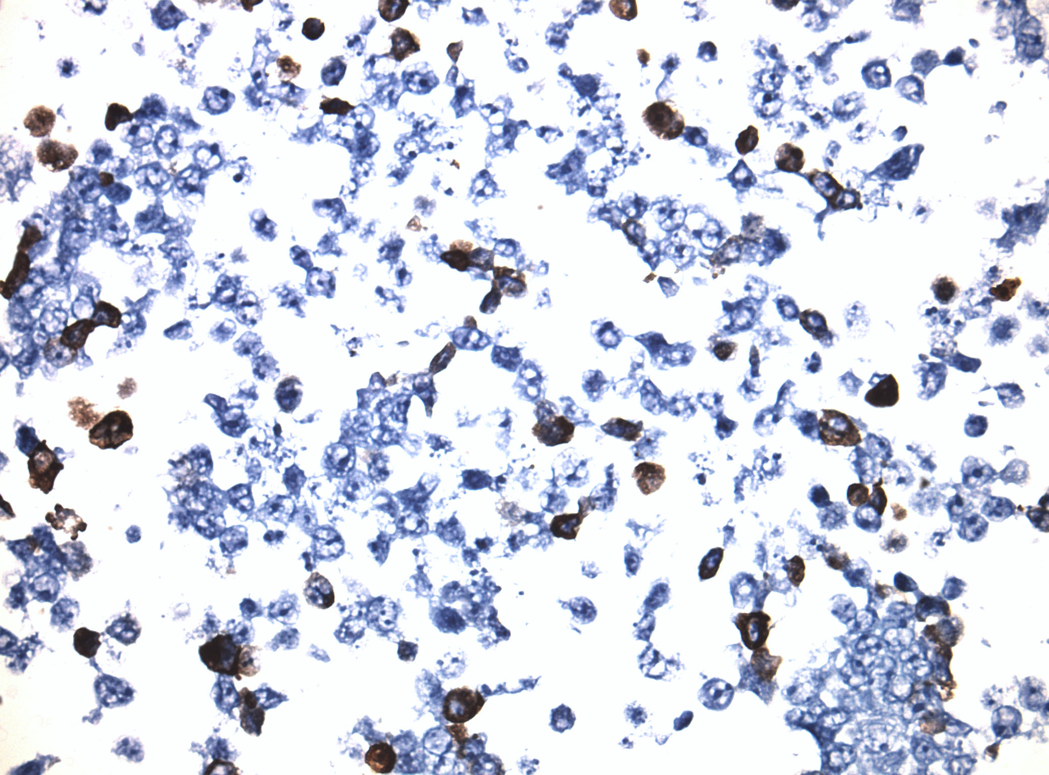 Immunohistology staining on MAST205 overexpressed cytosection TS409492P5 with mouse anti DDK clone OTI11C3 C/N TA180144 at 1:400 dilution 4C O/N. Antibody staining was achieved with HIER Citrate pH6 , Polink1 with DAB chromogen detection kit (D11-18). Positive stain shown with the brown chromogen present. HEK293T cells were transfected with cDNA clone RC209492, 5 micron sections, 40x magnification