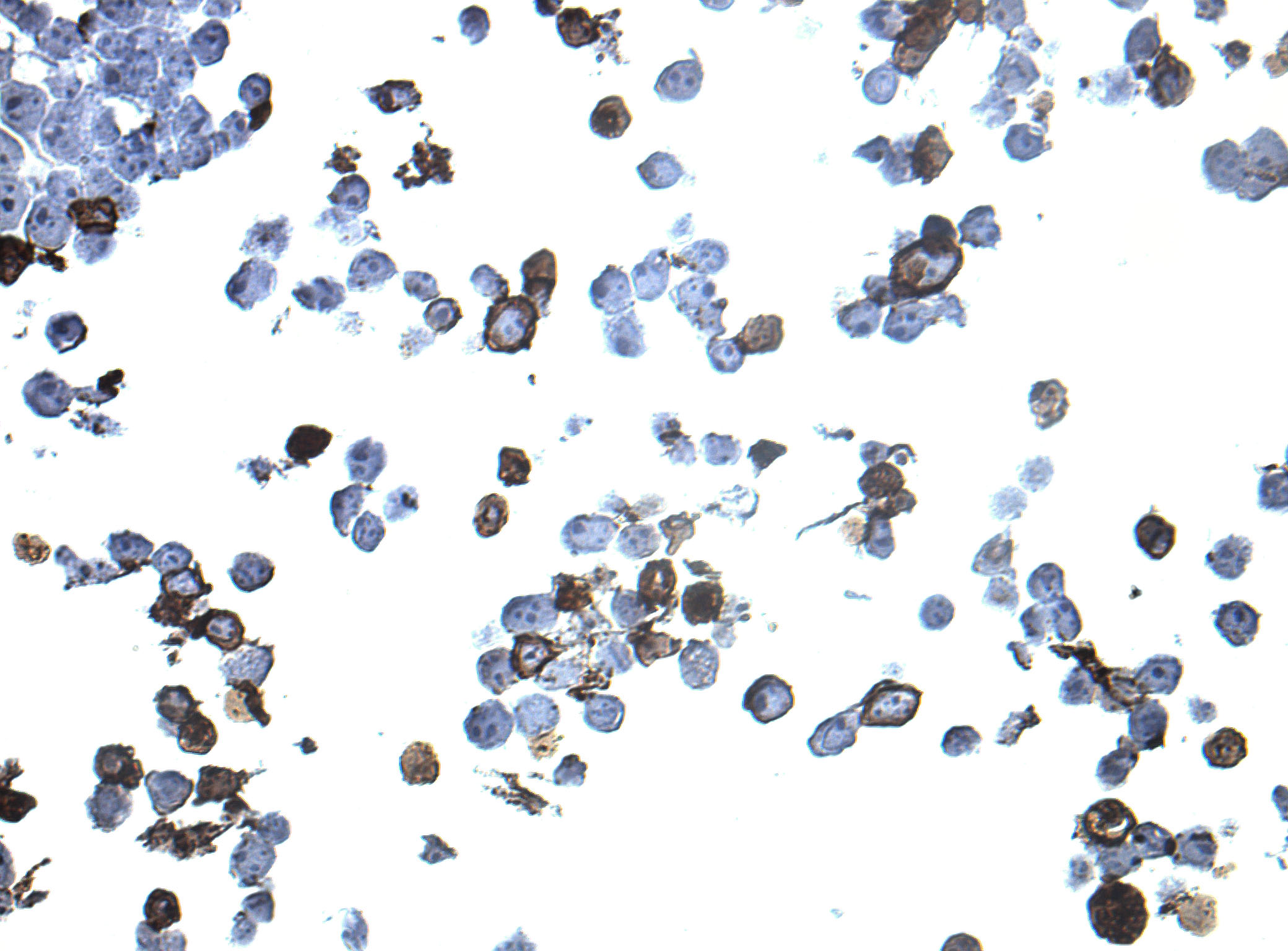 Immunohistology staining on PCDHGA2 overexpressed cytosection TS410863P5 with mouse anti DDK clone OTI11C3 C/N TA180144 at 1:400 dilution 4C O/N. Antibody staining was achieved with HIER Citrate pH6 , Polink1 with DAB chromogen detection kit (D11-18). Positive stain shown with the brown chromogen present. HEK293T cells were transfected with cDNA clone RC210863, 5 micron sections, 40x magnification