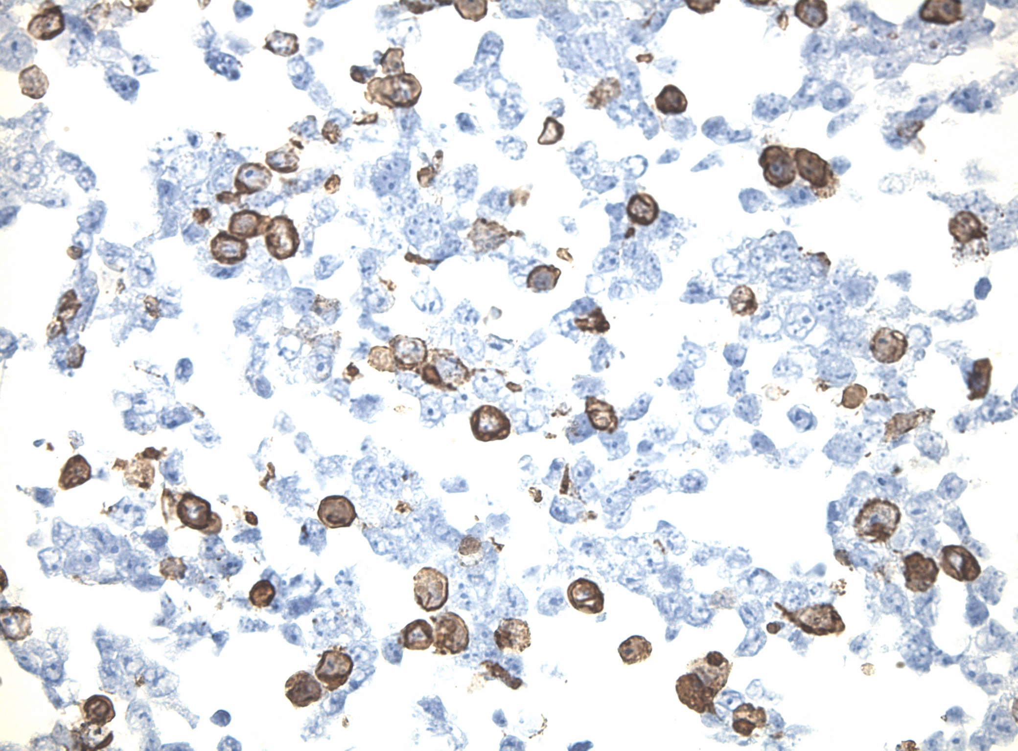 Immunohistology staining on PCDHGB2 overexpressed cytosection TS411028P5 with rabbit anti DDK clone OTIR5G2 C/N TA592569 at 1:2000 dilution 20m RT. Antibody staining was achieved with HIER Citrate pH6 , Polink1 with DAB chromogen detection kit (D11-18). Positive stain shown with the brown chromogen present. HEK293T cells were transfected with cDNA clone RC211028, 5 micron sections, 40x magnification