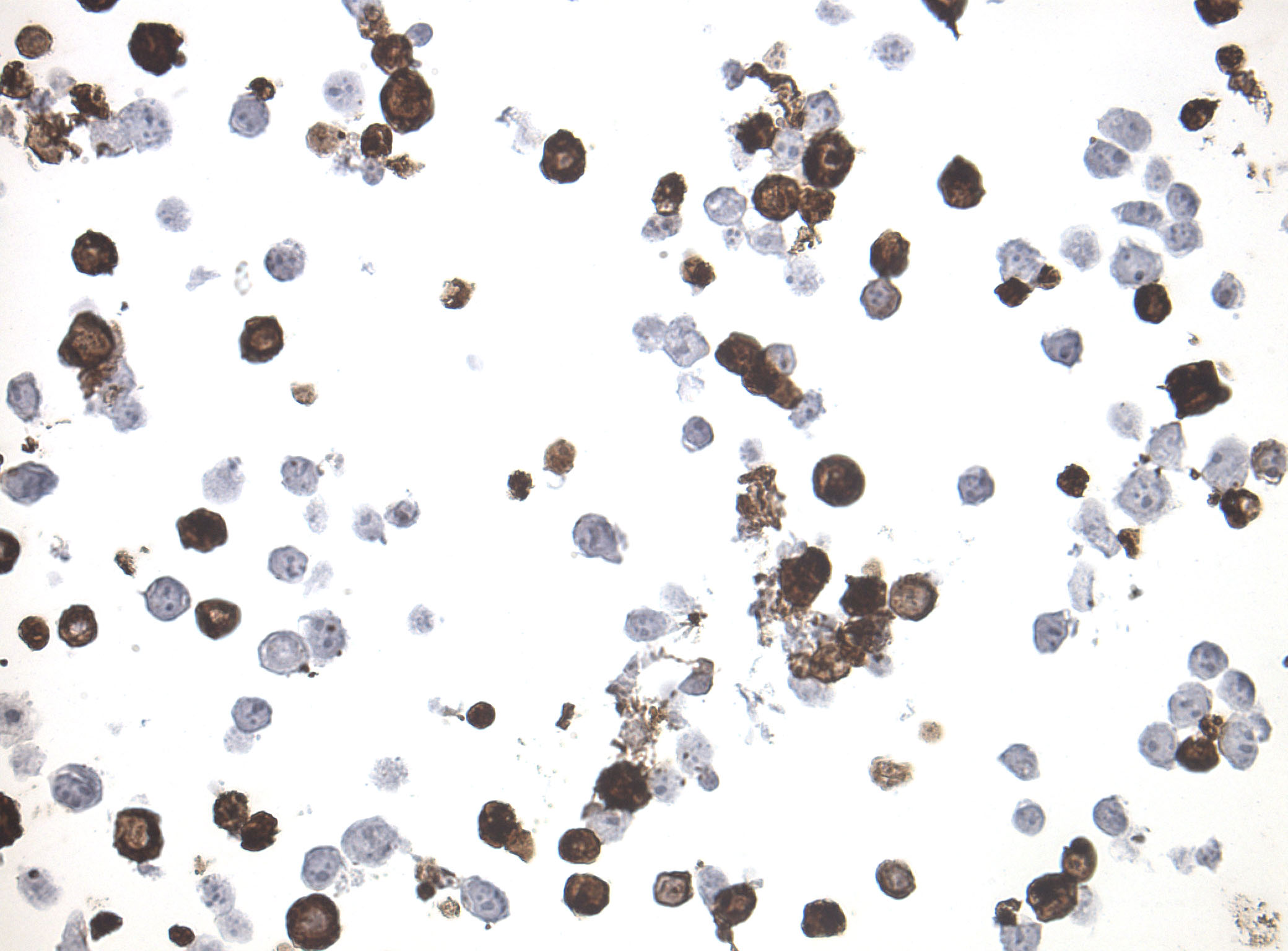 Immunohistology staining on PCDHA4 overexpressed cytosection TS411327P5 with mouse anti DDK clone OTI11C3 C/N TA180144 at 1:400 dilution 4C O/N. Antibody staining was achieved with HIER Citrate pH6 , Polink1 with DAB chromogen detection kit (D11-18). Positive stain shown with the brown chromogen present. HEK293T cells were transfected with cDNA clone RC211327, 5 micron sections, 40x magnification