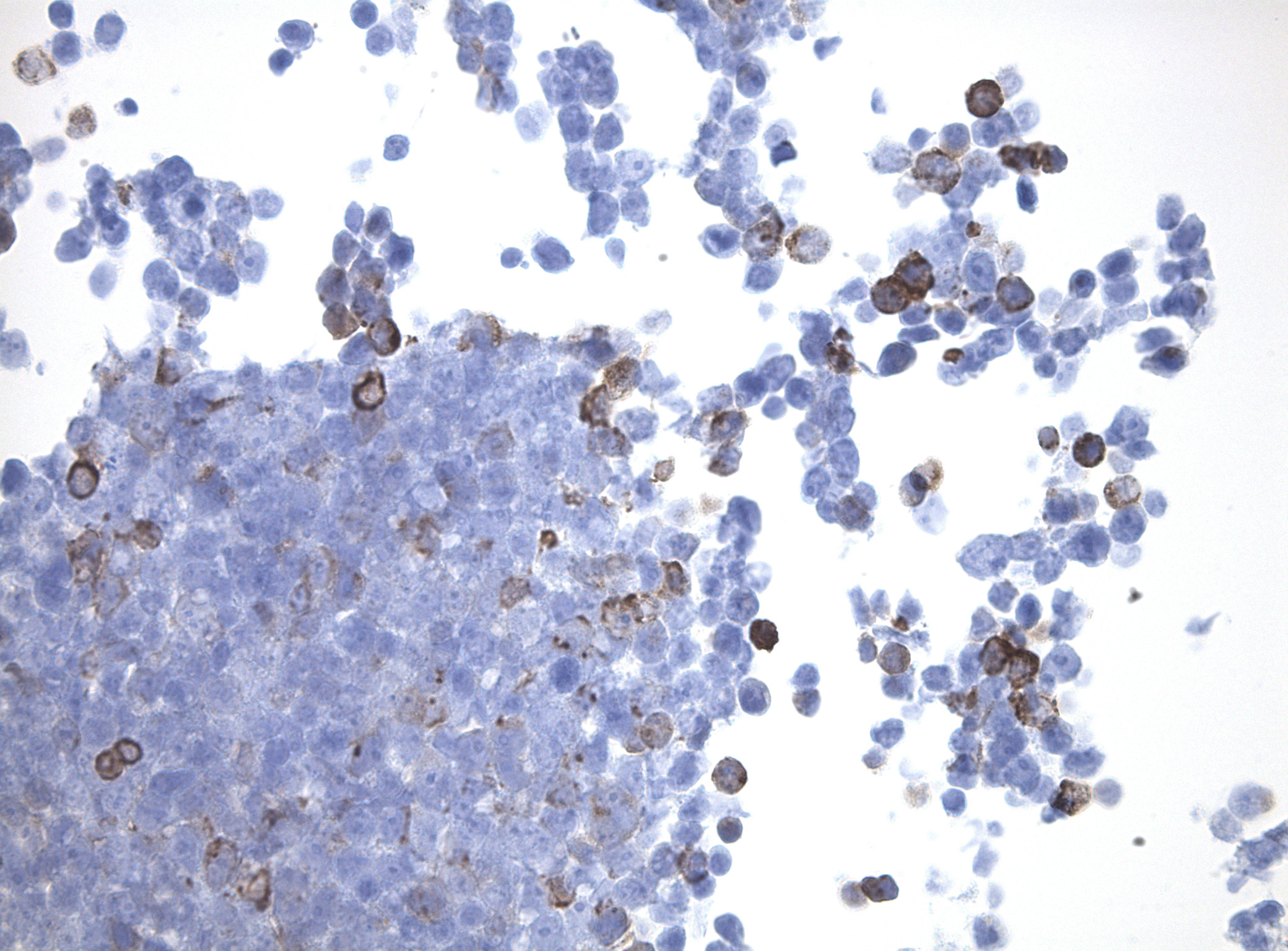 Immunohistology staining on COL10A1 overexpressed cytosection TS411658P5 with rabbit anti DDK clone OTIR5G2 C/N TA592569 at 1:2000 dilution 20m RT. Antibody staining was achieved with HIER Citrate pH6 , Polink1 with DAB chromogen detection kit (D11-18). Positive stain shown with the brown chromogen present. HEK293T cells were transfected with cDNA clone RC211658, 5 micron sections, 40x magnification