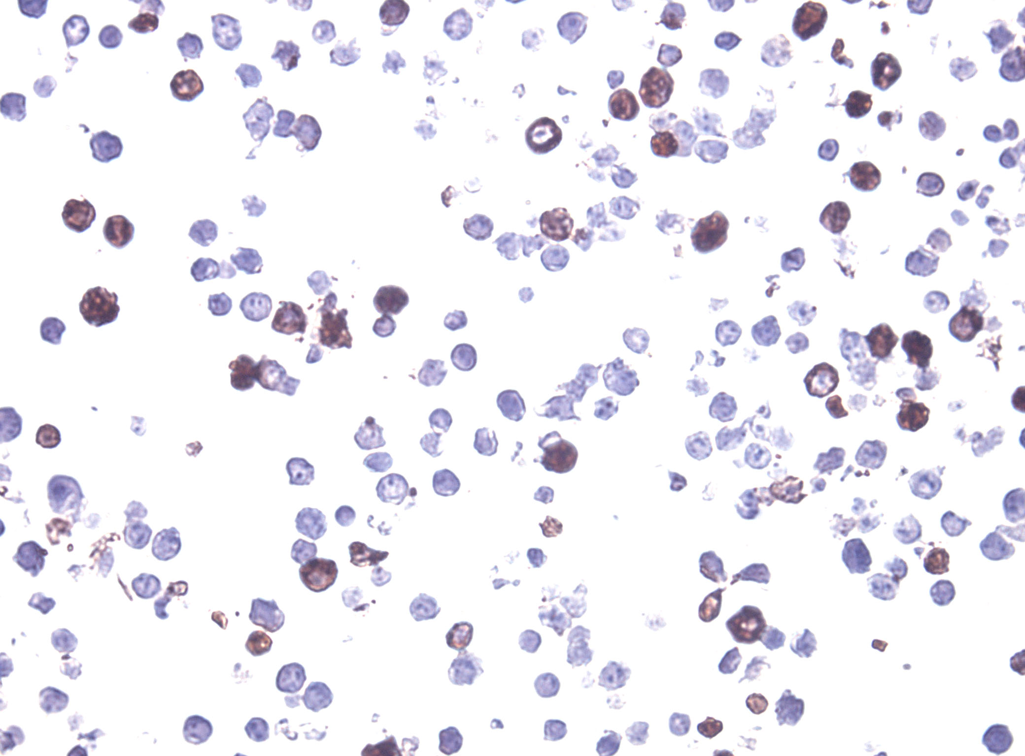 Immunohistology staining on LY6K overexpressed cytosection TS412498P5 with mouse anti DDK clone OTI11C3 C/N TA180144 at 1:400 dilution 4C O/N. Antibody staining was achieved with HIER Citrate pH6 , Polink1 with DAB chromogen detection kit (D11-18). Positive stain shown with the brown chromogen present. HEK293T cells were transfected with cDNA clone RC212498, 5 micron sections, 40x magnification