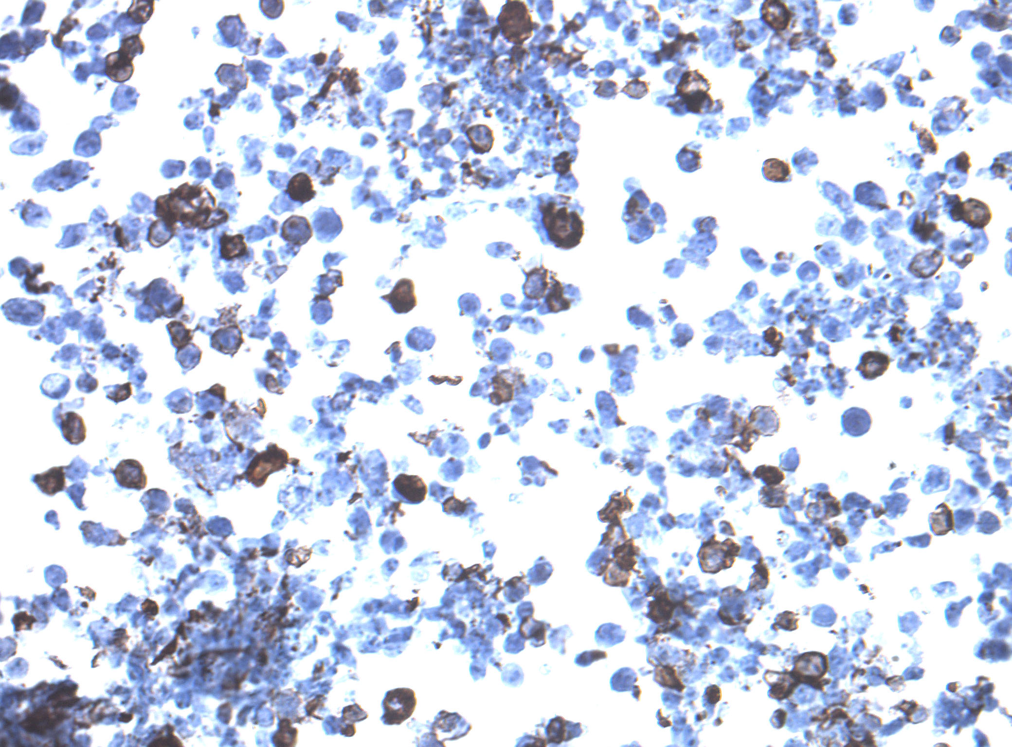 Immunohistology staining on ATP2B4 overexpressed cytosection TS413835P5 with mouse anti DDK clone OTI11C3 C/N TA180144 at 1:400 dilution 4C O/N. Antibody staining was achieved with HIER Citrate pH6 , Polink1 with DAB chromogen detection kit (D11-18). Positive stain shown with the brown chromogen present. HEK293T cells were transfected with cDNA clone RC213835, 5 micron sections, 40x magnification