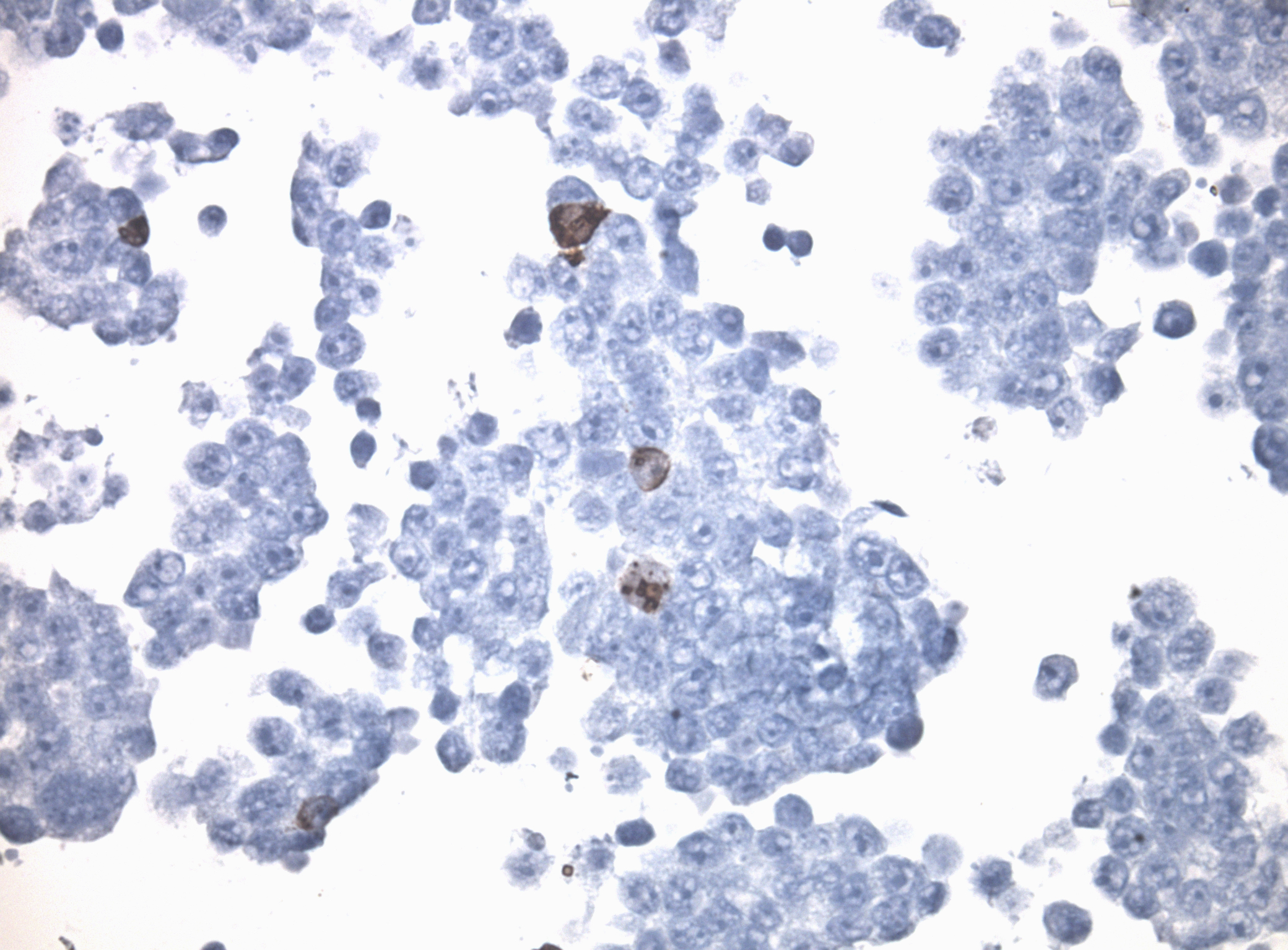 Immunohistology staining on WWC3 overexpressed cytosection TS415823P5 with mouse anti DDK clone OTI11C3 C/N TA180144 at 1:400 dilution 4C O/N. Antibody staining was achieved with HIER Citrate pH6 , Polink1 with DAB chromogen detection kit (D11-18). Positive stain shown with the brown chromogen present. HEK293T cells were transfected with cDNA clone RC215823, 5 micron sections, 40x magnification