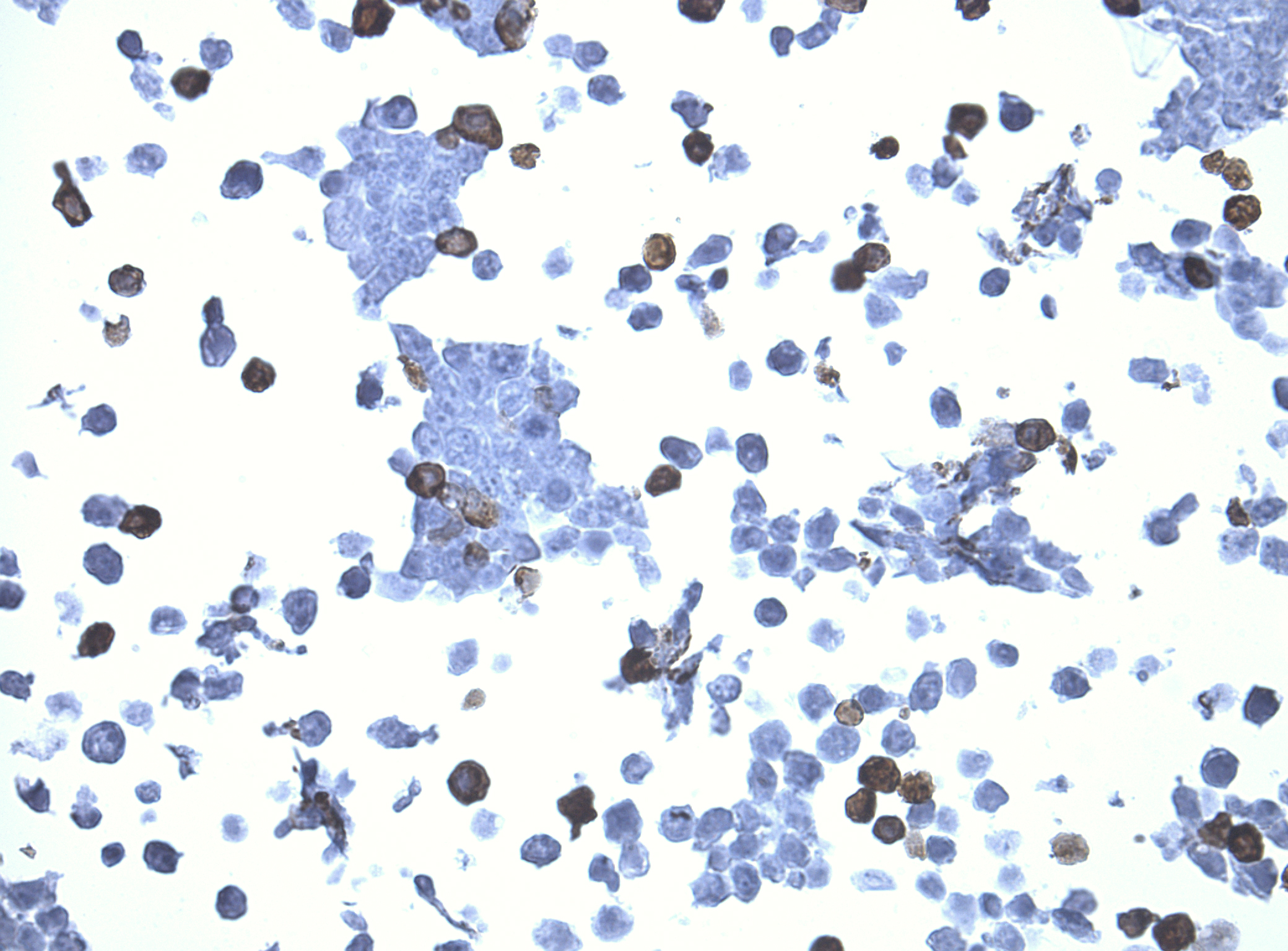 Immunohistology staining on PCDHA8 overexpressed cytosection TS418888P5 with mouse anti DDK clone OTI11C3 C/N TA180144 at 1:400 dilution 4C O/N. Antibody staining was achieved with HIER Citrate pH6 , Polink1 with DAB chromogen detection kit (D11-18). Positive stain shown with the brown chromogen present. HEK293T cells were transfected with cDNA clone RC218888, 5 micron sections, 40x magnification