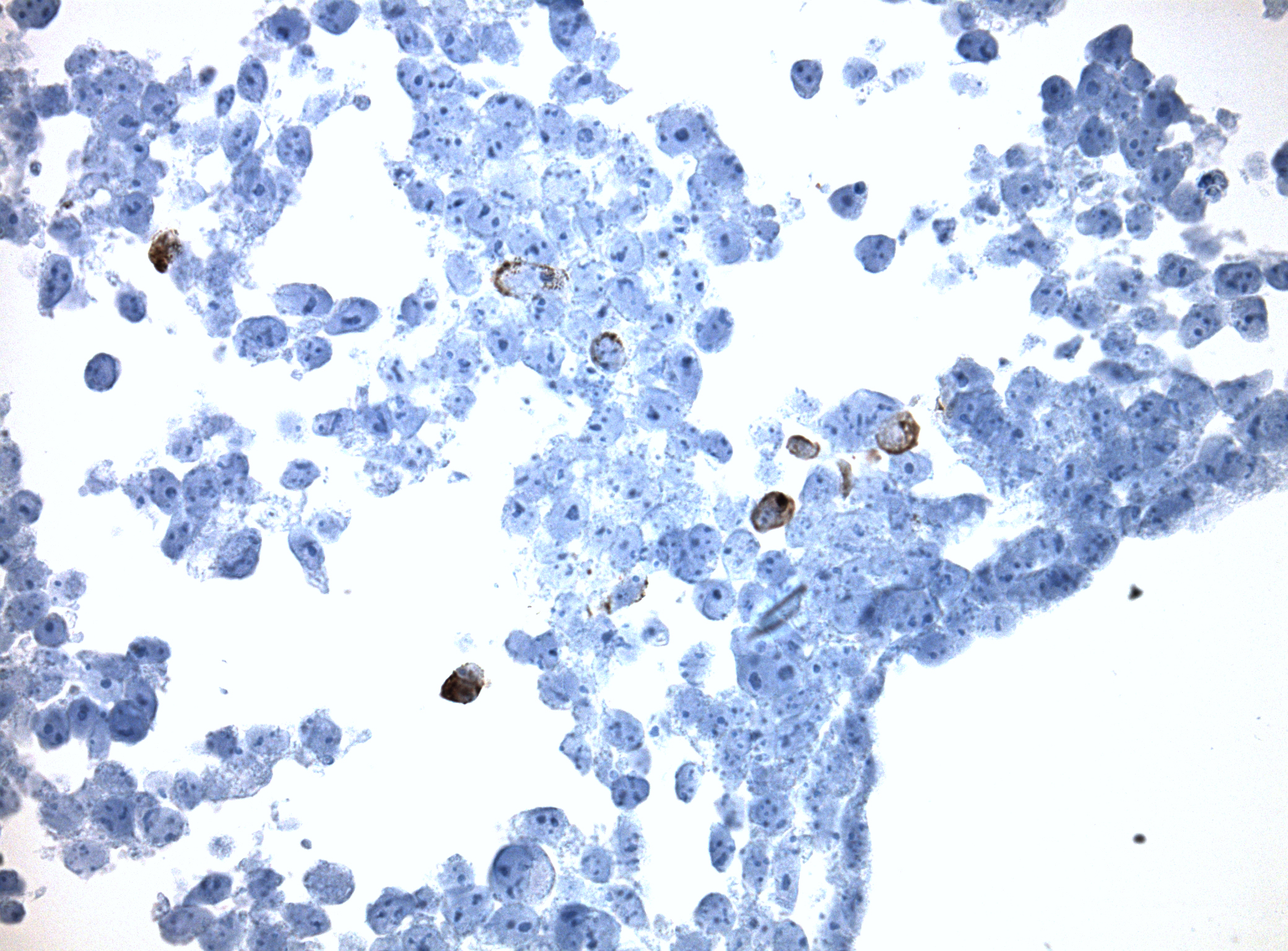Immunohistology staining on ULBP3 overexpressed cytosection TS419672P5 with mouse anti DDK clone OTI11C3 C/N TA180144 at 1:400 dilution 4C O/N. Antibody staining was achieved with HIER Citrate pH6 , Polink1 with DAB chromogen detection kit (D11-18). Positive stain shown with the brown chromogen present. HEK293T cells were transfected with cDNA clone RC419672, 5 micron sections, 40x magnification