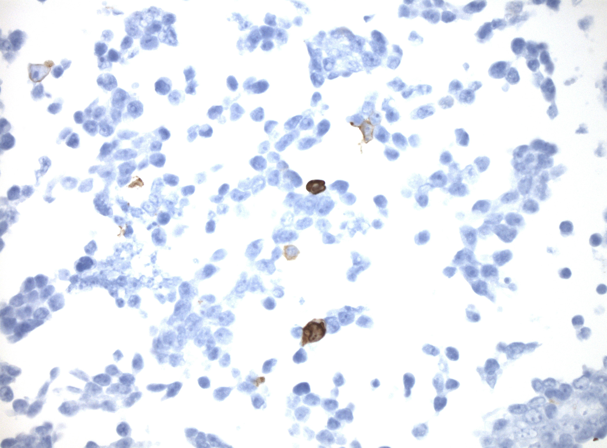 Immunohistology staining on PCDHGB7 overexpressed cytosection TS422084P5 with rabbit anti DDK clone OTIR5G2 C/N TA592569 at 1:2000 dilution 20m RT. Antibody staining was achieved with HIER Citrate pH6 , Polink1 with DAB chromogen detection kit (D11-18). Positive stain shown with the brown chromogen present. HEK293T cells were transfected with cDNA clone RC222084, 5 micron sections, 40x magnification