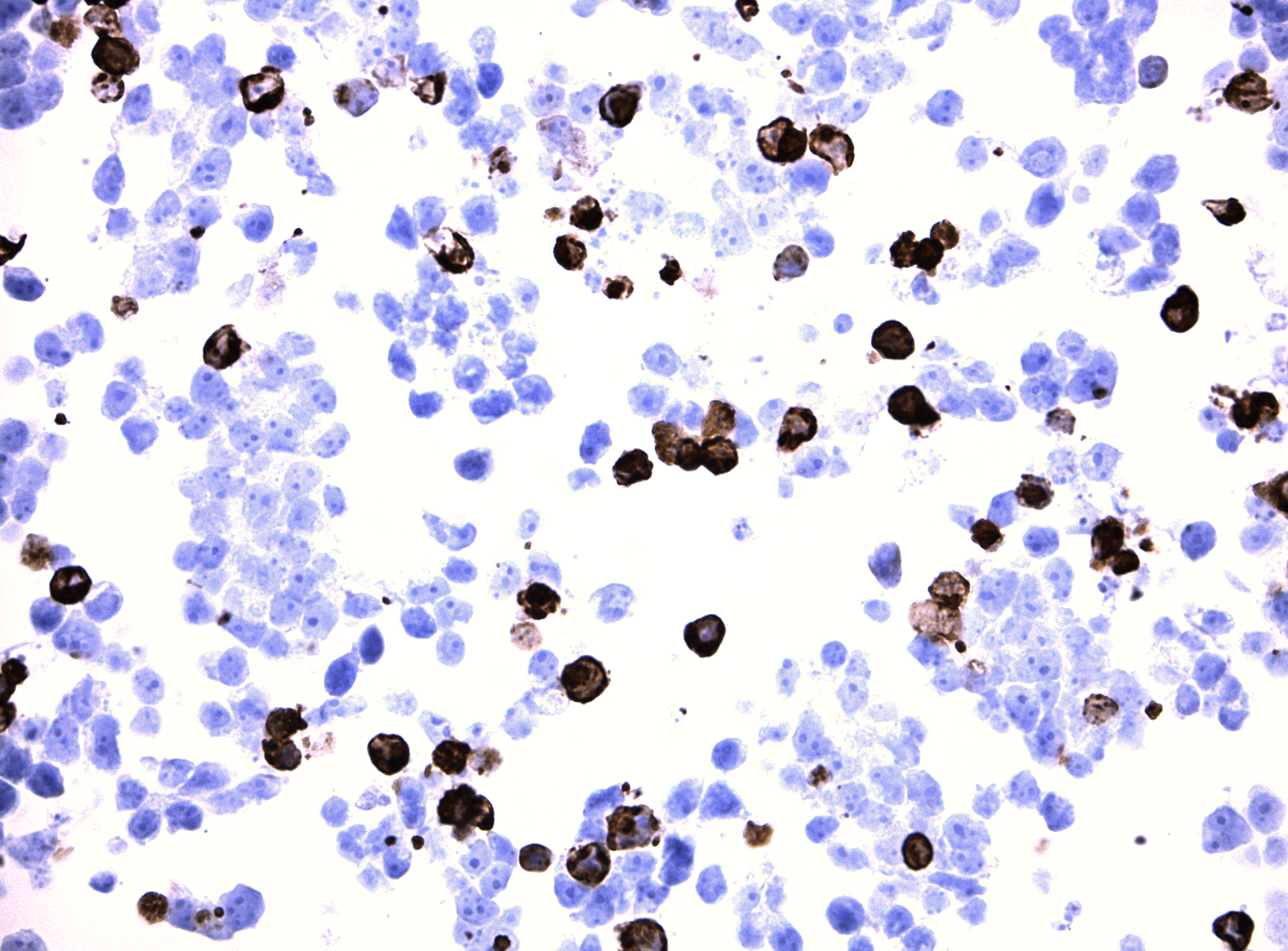 Immunohistology staining on OR2T35 overexpressed cytosection TS424248P5 with mouse anti DDK clone OTI11C3 C/N TA180144 at 1:400 dilution 4C O/N. Antibody staining was achieved with HIER Citrate pH6 , Polink1 with DAB chromogen detection kit (D11-18). Positive stain shown with the brown chromogen present. HEK293T cells were transfected with cDNA clone RC424248, 5 micron sections, 40x magnification