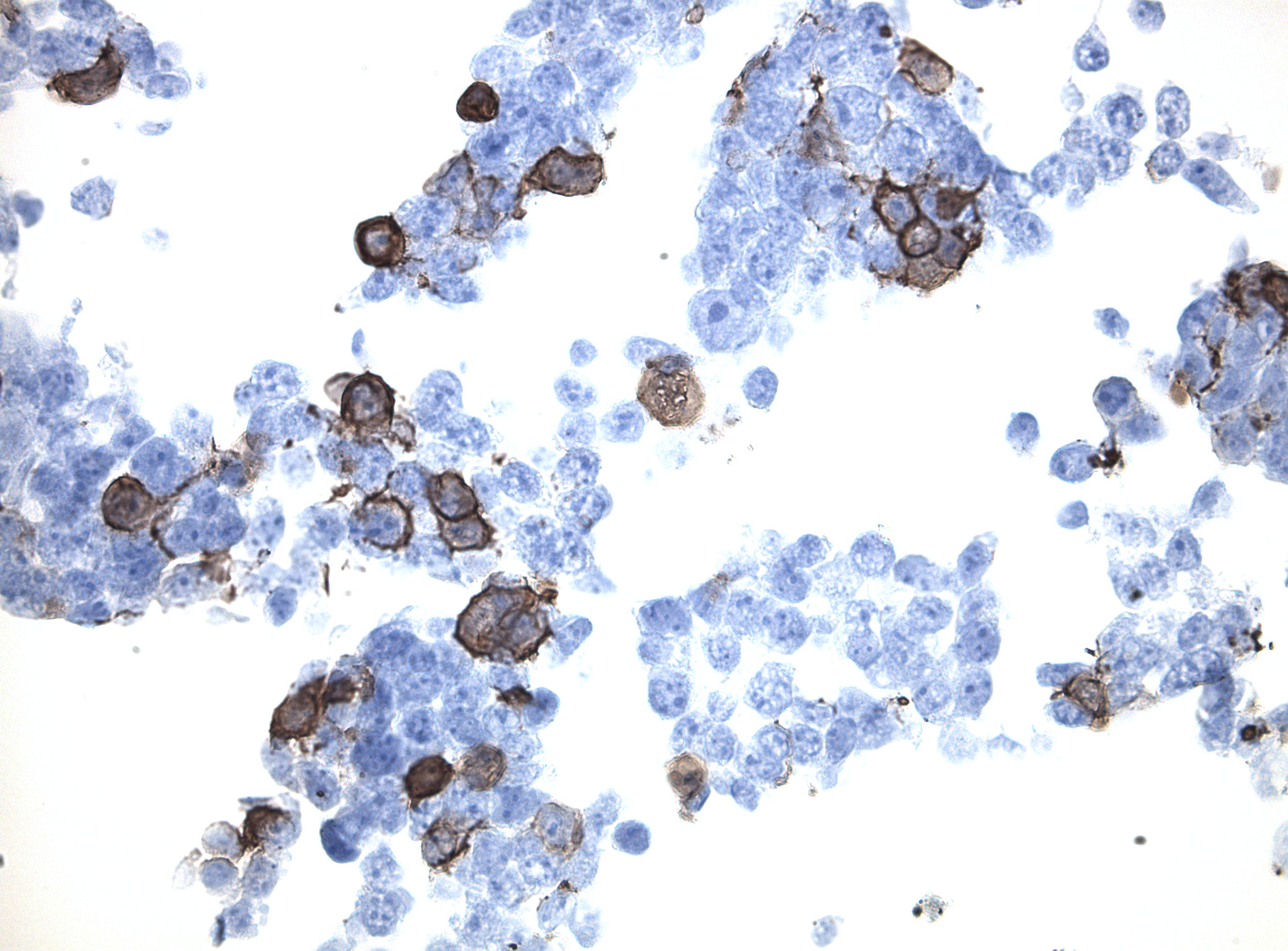 Immunohistology staining on CLDN22 overexpressed cytosection TS425263P5 with rabbit anti DDK clone OTIR5G2 C/N TA592569 at 1:2000 dilution 20m RT. Antibody staining was achieved with HIER Citrate pH6 , Polink1 with DAB chromogen detection kit (D11-18). Positive stain shown with the brown chromogen present. HEK293T cells were transfected with cDNA clone RC225263, 5 micron sections, 40x magnification