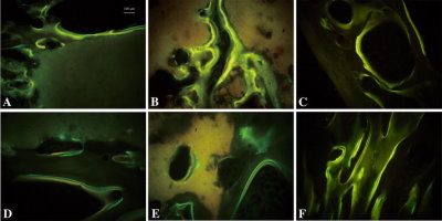 At 45 days, the bone mineralization rates of the (A) rhBMP-2/CPC and the (B) rhBMP-2/GM/CPC groups were greater than those of the (C) untreated group, and the rates of the rhBMP-2/GM/CPC group were greater than those of the rhBMP-2/CPC group. However, there were no differences in the mineralization rates among the (D) rhBMP-2/CPC, (E) rhBMP-2/GM/CPC, and (F) untreated groups at 140 days (Double fluorescent labeling; original magnification, x100). Clinical Orthopaedics and Related Research® (c) The Association of Bone and Joint Surgeons® 2010 10.1007/s11999-010-1321-9