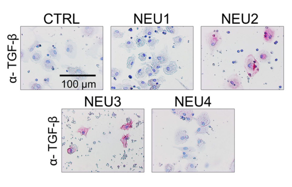 NEU2 and NEU3 upregulate TGF-beta1 by PBMC. Human PBMC were incubated with or without recombinant human sialidases, NEU1 (OriGene TP300386), NEU2 (OriGene TP319858), NEU3 (OriGene TP316537), NEU4 (OriGene TP303948) for five days, then air-dried and stained for TGF-beta1. Positive staining appears pink, and counterstaining is blue. Bar is 0.1 mm. Figure cited from Sci Rep, PMID: 29118338