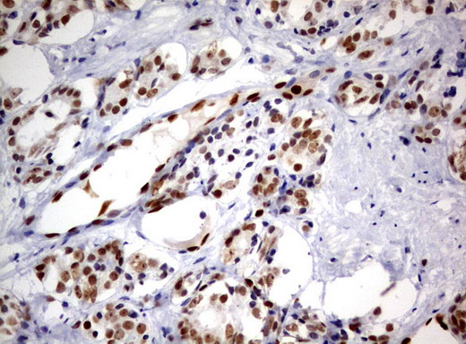 Immunohistochemical staining of paraffin-embedded Carcinoma of Human prostate tissue using anti-ERG mouse monoclonal antibody. (UM500064; heat-induced epitope retrieval by 10mM citric buffer, pH6.0, 120°C for 3min)