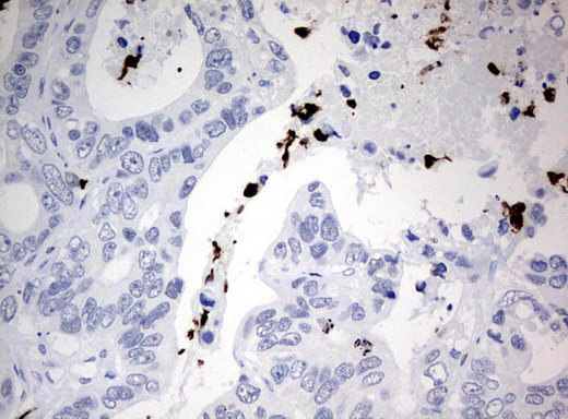 Immunohistochemical staining of paraffin-embedded Adenocarcinoma of Human colon tissue using anti-PBX1 mouse monoclonal antibody. (UM500077; heat-induced epitope retrieval by 10mM citric buffer, pH6.0, 120°C for 3min)