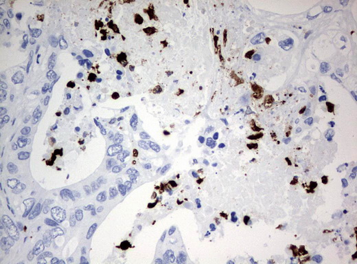 Immunohistochemical staining of paraffin-embedded Adenocarcinoma of Human colon tissue using anti-PBX1 mouse monoclonal antibody. (UM500078; heat-induced epitope retrieval by 10mM citric buffer, pH6.0, 120°C for 3min)