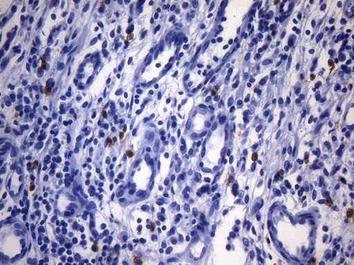 Immunohistochemical staining of paraffin-embedded human gastric carcinoma using anti-KIT mouse monoclonal antibody. HIER pretreatment was done with 1mM EDTA in 10mM Tris buffer (pH8.0) at 120°C for 2.5 minutes. UM800108 was diluted 1:400 and detection was done with HRP secondary and DAB chromogen. Cytoplasmic and mebraneous positive stain seen in very few tumor cells.