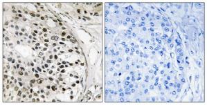 Immunohistochemistry analysis of paraffin-embedded human breast carcinoma tissue using MNK1 antibodyThe picture on the right is treated with the synthesized peptide.