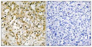 Immunohistochemistry analysis of paraffin-embedded human liver carcinoma tissue, using TFAM antibody.The picture on the right is treated with the synthesized peptide.