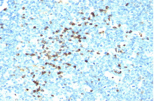 Formalin-Fixed, Paraffin-Embedded Human tonsil stained with Lambda Antibody Cat.-No AM33322PU (Clone LAM03).Note cell membrane and cytoplasmic staining.