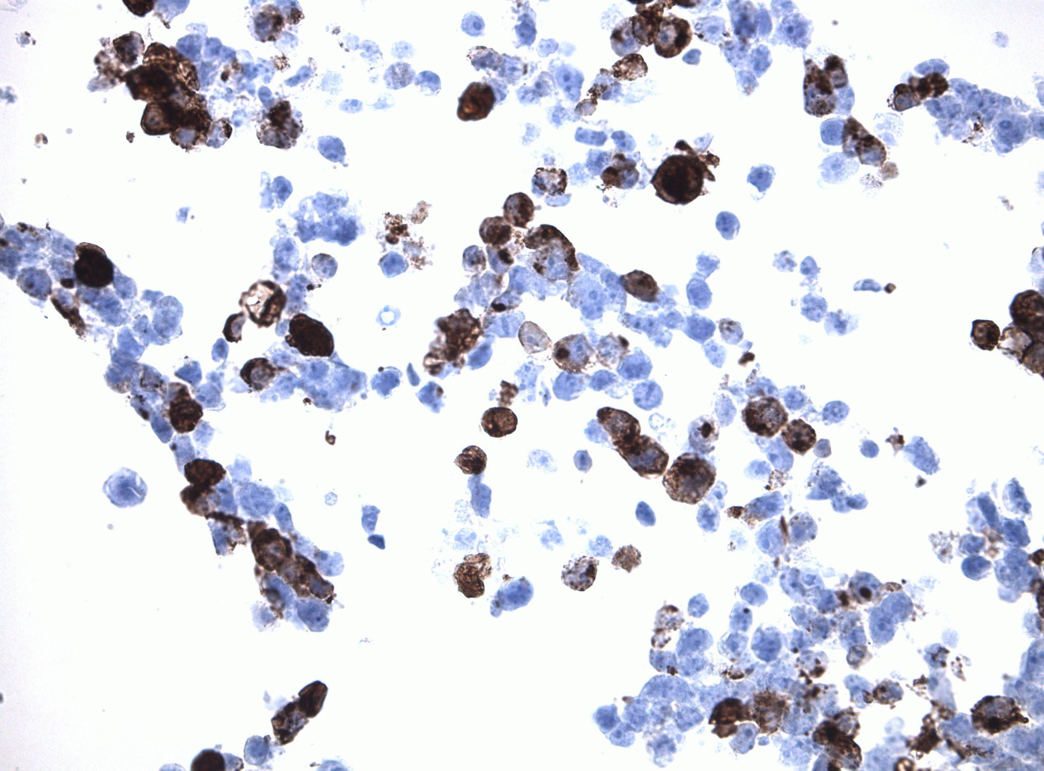 Immunohistology staining on IL6 overexpressed cytosection [TS402078P5] with rabbit anti DDK clone OTIR5G2  C/N TA592569 at 1:2000 dilution 20m RT. Antibody staining was achieved with HIER Citrate pH6 , Polink1 with DAB chromogen detection kit ([D11-18]). Positive stain shown with the brown chromogen present. HEK293T cells were transfected with cDNA clone [RC202078], 5 micron sections, 40x magnification