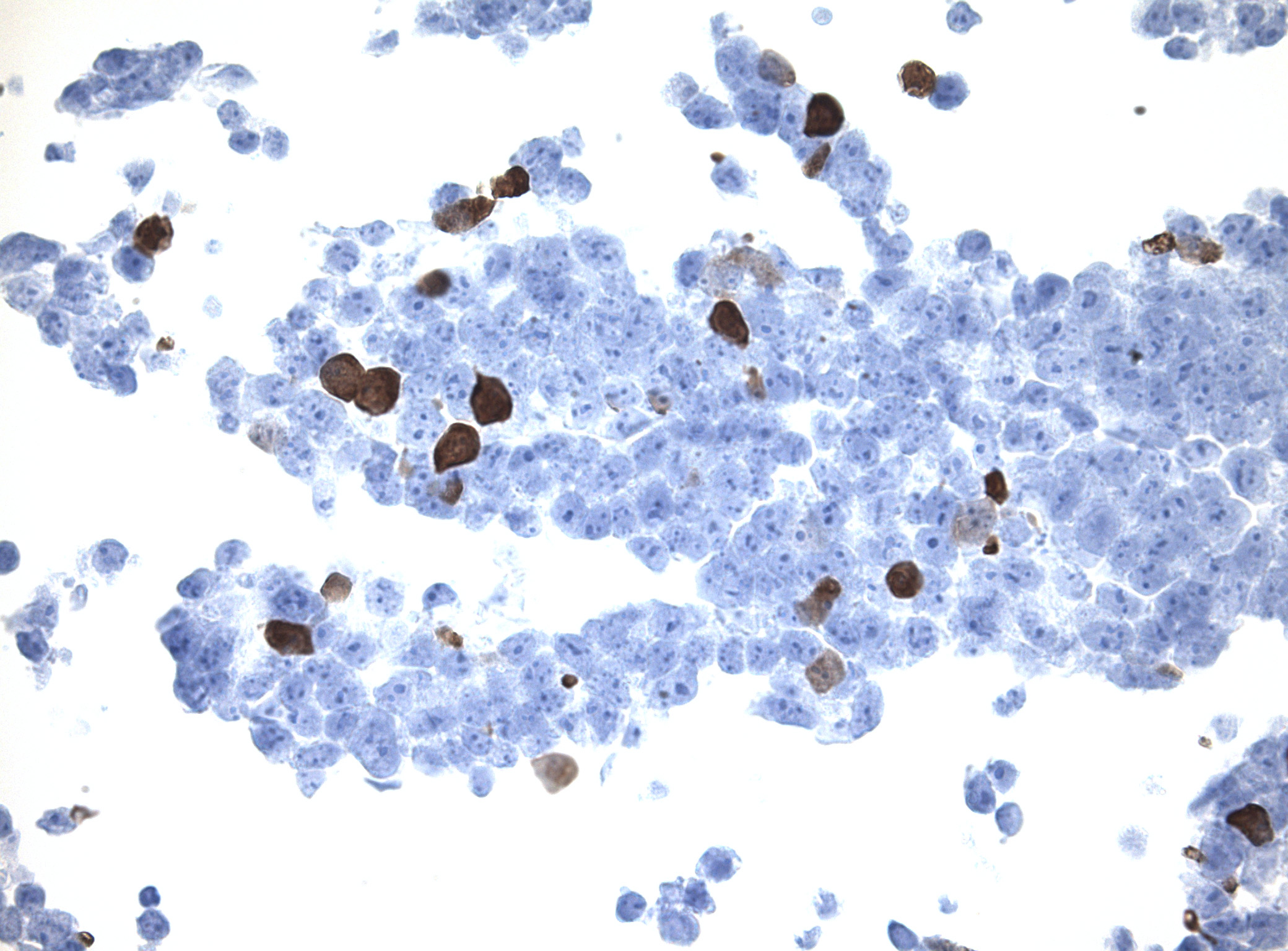 Immunohistology staining on IL1B overexpressed cytosection [TS402079P5] with rabbit anti DDK clone OTIR5G2  C/N TA592569 at 1:2000 dilution 20m RT. Antibody staining was achieved with HIER Citrate pH6 , Polink1 with DAB chromogen detection kit ([D11-18]). Positive stain shown with the brown chromogen present. HEK293T cells were transfected with cDNA clone [RC202079], 5 micron sections, 40x magnification