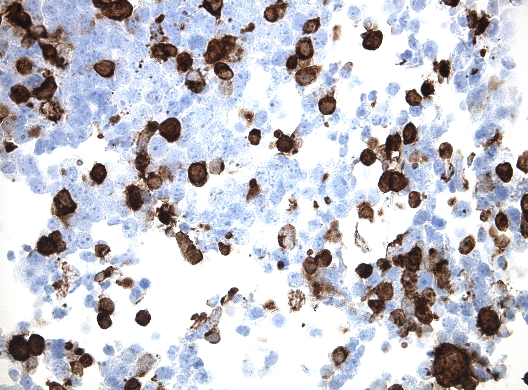 Immunohistology staining on IL11 overexpressed cytosection [TS404493P5] with rabbit anti DDK clone OTIR5G2  C/N TA592569 at 1:2000 dilution 20m RT. Antibody staining was achieved with HIER Citrate pH6 , Polink1 with DAB chromogen detection kit ([D11-18]). Positive stain shown with the brown chromogen present. HEK293T cells were transfected with cDNA clone [RC204493], 5 micron sections, 40x magnification