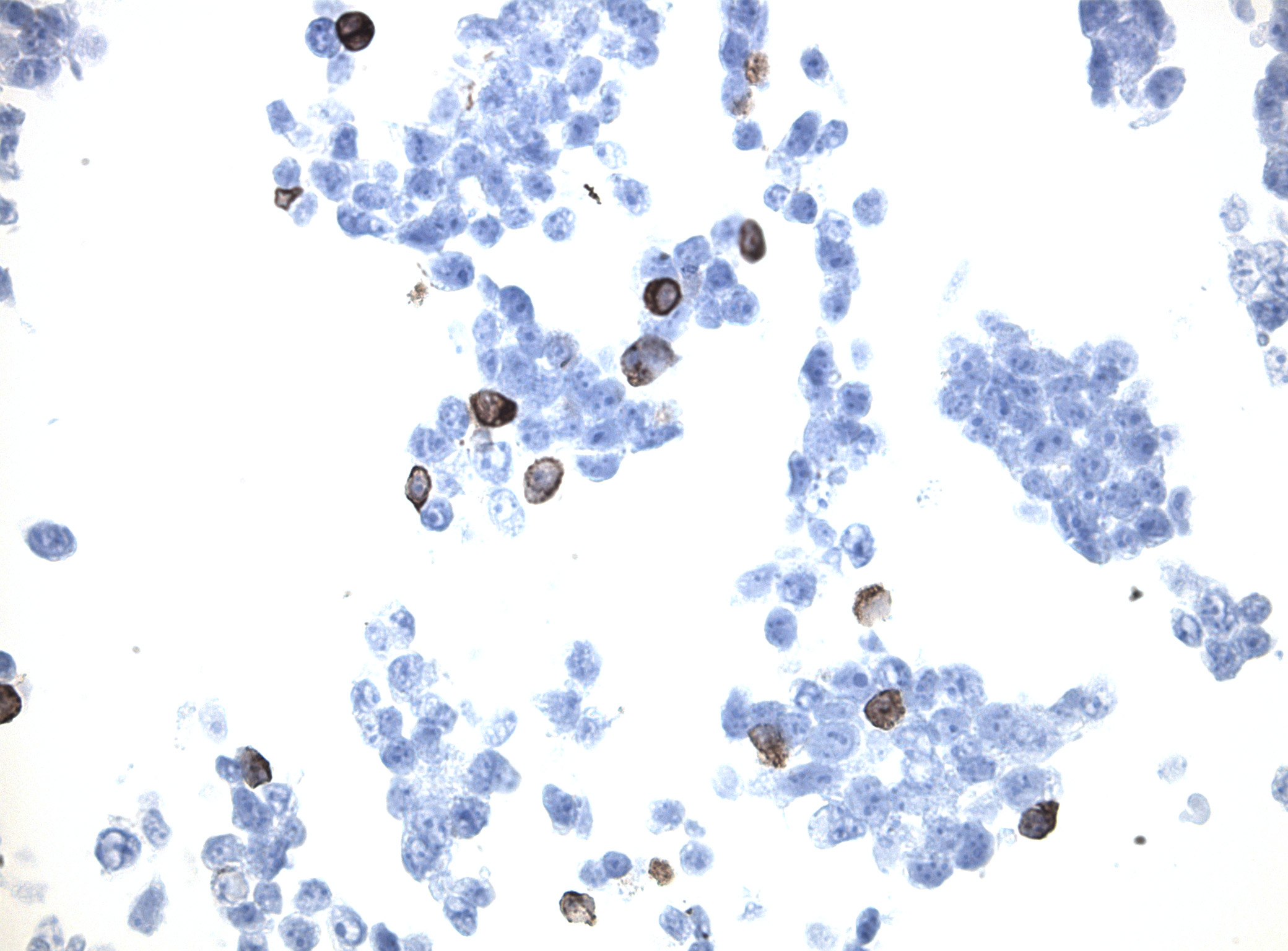Immunohistology staining on CH25H overexpressed cytosection [TS404716P5] with rabbit anti DDK clone OTIR5G2  C/N TA592569 at 1:2000 dilution 20m RT. Antibody staining was achieved with HIER Citrate pH6 , Polink1 with DAB chromogen detection kit ([D11-18]). Positive stain shown with the brown chromogen present. HEK293T cells were transfected with cDNA clone [RC204716], 5 micron sections, 40x magnification