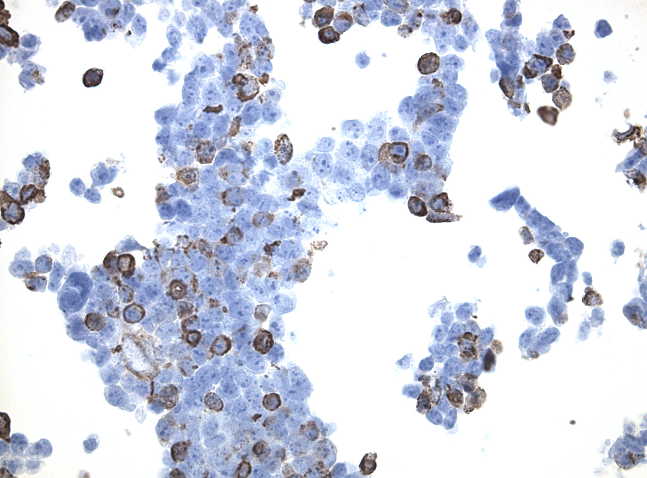 Immunohistology staining on SPON2 overexpressed cytosection [TS406764P5] with rabbit anti DDK clone OTIR5G2  C/N TA592569 at 1:2000 dilution 20m RT. Antibody staining was achieved with HIER Citrate pH6 , Polink1 with DAB chromogen detection kit ([D11-18]). Positive stain shown with the brown chromogen present. HEK293T cells were transfected with cDNA clone [RC206764], 5 micron sections, 40x magnification