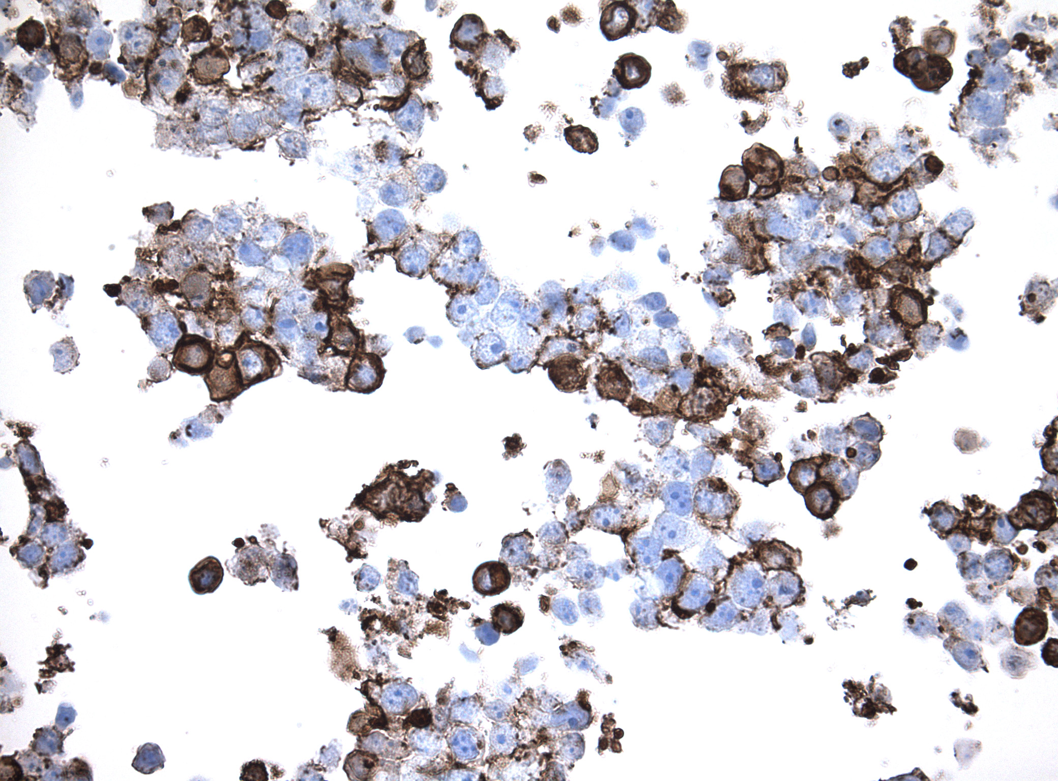 Immunohistology staining on TNF overexpressed cytosection [TS406983P5] with rabbit anti DDK clone OTIR5G2  C/N TA592569 at 1:2000 dilution 20m RT. Antibody staining was achieved with HIER Citrate pH6 , Polink1 with DAB chromogen detection kit ([D11-18]). Positive stain shown with the brown chromogen present. HEK293T cells were transfected with cDNA clone [RC206983], 5 micron sections, 40x magnification