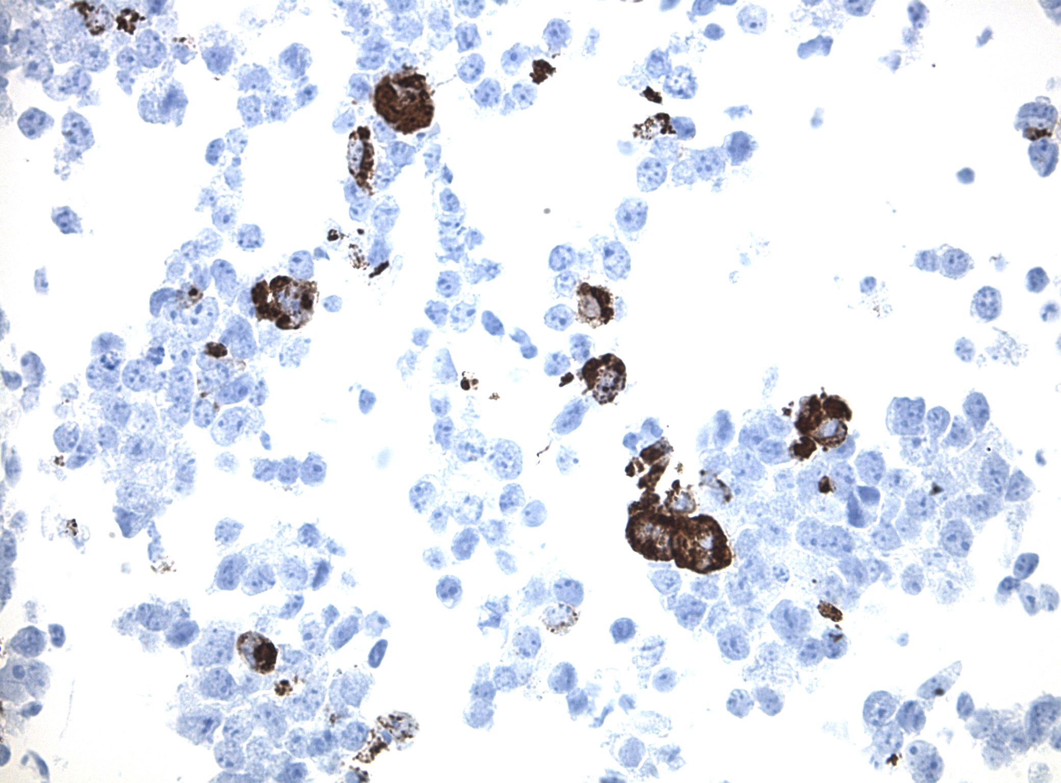Immunohistology staining on IL10 overexpressed cytosection [TS416785P5] with rabbit anti DDK clone OTIR5G2  C/N TA592569 at 1:2000 dilution 20m RT. Antibody staining was achieved with HIER Citrate pH6 , Polink1 with DAB chromogen detection kit ([D11-18]). Positive stain shown with the brown chromogen present. HEK293T cells were transfected with cDNA clone [RC216785], 5 micron sections, 40x magnification