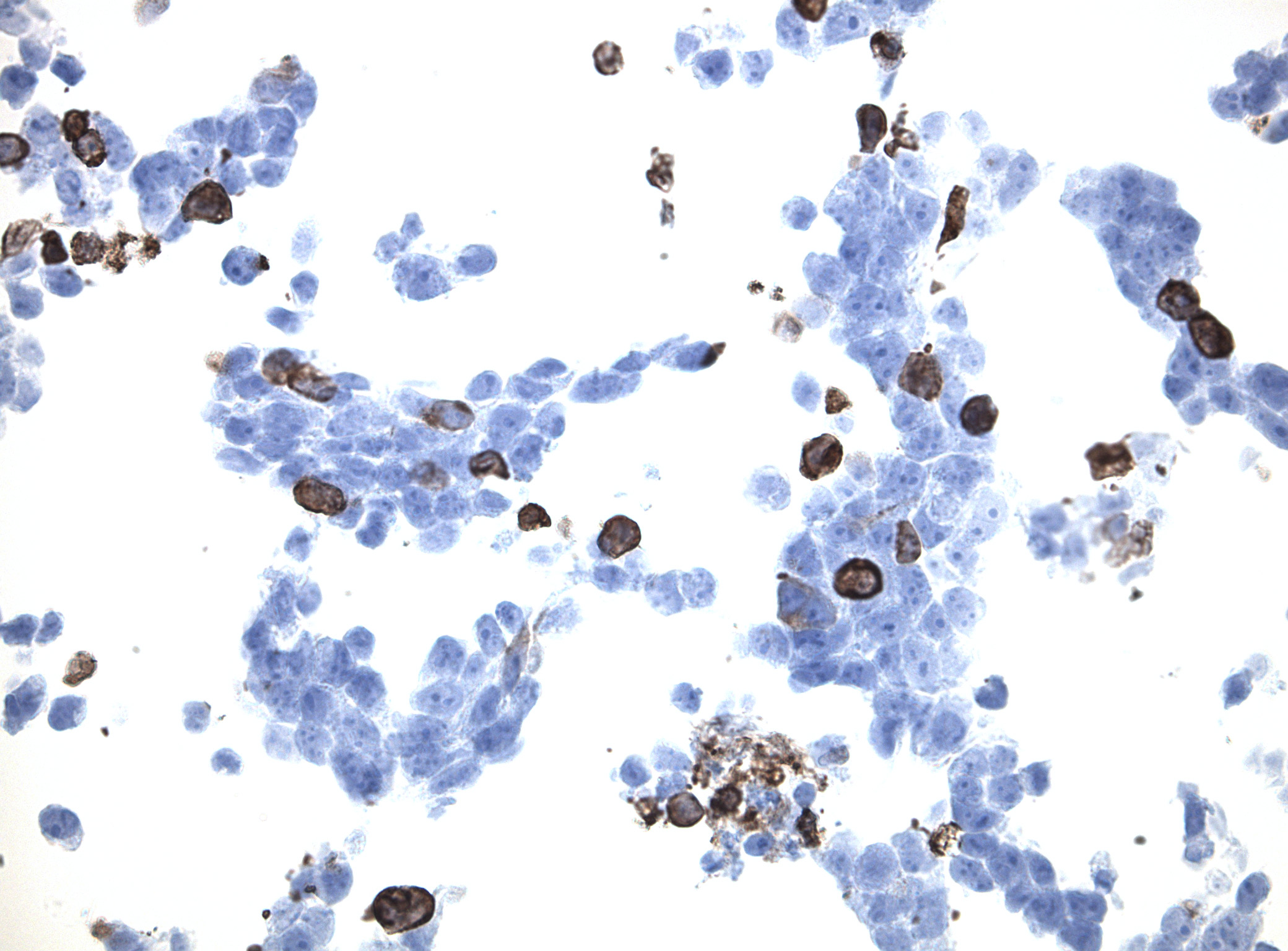 Immunohistology staining on PCDHA11 overexpressed cytosection [TS421707P5] with rabbit anti DDK clone OTIR5G2  C/N TA592569 at 1:2000 dilution 20m RT. Antibody staining was achieved with HIER Citrate pH6 , Polink1 with DAB chromogen detection kit ([D11-18]). Positive stain shown with the brown chromogen present. HEK293T cells were transfected with cDNA clone [RC221707], 5 micron sections, 40x magnification