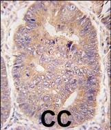 Formalin-fixed and paraffin-embedded human colon carcinoma tissue reacted with hTASP1-C-term (Cat.#AP11325PU-N), which was peroxidase-conjugated to the secondary antibody, followed by DAB staining. This data demonstrates the use of this antibody for immunohistochemistry; clinical relevance has not been evaluated.