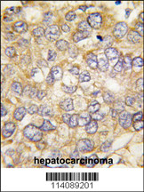 Formalin-fixed and paraffin-embedded human hepatocarcinoma tissue reacted with CHRD antibody (C-term) (Cat.#AP11375PU-N), which was peroxidase-conjugated to the secondary antibody, followed by DAB staining. This data demonstrates the use of this antibody for immunohistochemistry; clinical relevance has not been evaluated.