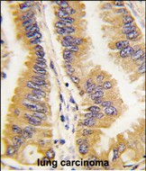 Formalin-fixed and paraffin-embedded human lung carcinoma tissue reacted with FRAT1 antibody (C-term) (Cat.#AP11407PU-N), which was peroxidase-conjugated to the secondary antibody, followed by DAB staining. This data demonstrates the use of this antibody for immunohistochemistry; clinical relevance has not been evaluated.