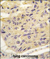 Formalin-fixed and paraffin-embedded human lung carcinoma tissue reacted with FRAT1 antibody (Center) (Cat.#AP11408PU-N), which was peroxidase-conjugated to the secondary antibody, followed by DAB staining. This data demonstrates the use of this antibody for immunohistochemistry; clinical relevance has not been evaluated.