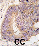 Formalin-fixed and paraffin-embedded human colon carcinoma tissue reacted with PDE8A antibody (Center) (L572)(Cat.#AP11453PU-N), which was peroxidase-conjugated to the secondary antibody, followed by DAB staining. This data demonstrates the use of this antibody for immunohistochemistry; clinical relevance has not been evaluated.