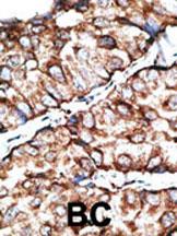 Formalin-fixed and paraffin-embedded human cancer tissue reacted with the primary antibody, which was peroxidase-conjugated to the secondary antibody, followed by DAB staining. This data demonstrates the use of this antibody for immunohistochemistry; clinical relevance has not been evaluated. BC = breast carcinoma; HC = hepatocarcinoma.