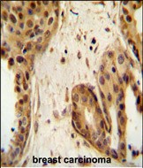 STAT2 Antibody (C-term) (Cat.#AP11564PU-N) immunohistochemistry analysis in formalin fixed and paraffin embedded human breast carcinoma followed by peroxidase conjugation of the secondary antibody and DAB staining.  This data demonstrates the use of the STAT2 Antibody (C-term) for immunohistochemistry.  Clinical relevance has not been evaluated.