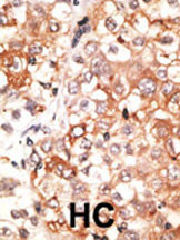 Formalin-fixed and paraffin-embedded human cancer tissue reacted with the primary antibody, which was peroxidase-conjugated to the secondary antibody, followed by DAB staining. This data demonstrates the use of this antibody for immunohistochemistry; clinical relevance has not been evaluated. BC = breast carcinoma; HC = hepatocarcinoma.