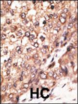 Formalin-fixed and paraffin-embedded human cancer tissue reacted with the primary antibody, which was peroxidase-conjugated to the secondary antibody, followed by DAB staining. This data demonstrates the use of this antibody for immunohistochemistry; clinical relevance has not been evaluated. BC = breast carcinoma; HC = hepatocarcinoma.