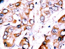 Formalin-fixed and paraffin-embedded human Hepatocellular carcinoma reacted with anti-HDBP2(HDRF-2) Antibody (Center), which was peroxidase-conjugated to the secondary antibody, followed by DAB staining. This data demonstrates the use of this antibody for immunohistochemistry; clinical relevance has not been evaluated.