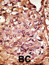 Formalin-fixed and paraffin-embedded human cancer tissue reacted with the primary antibody, which was peroxidase-conjugated to the secondary antibody, followed by AEC staining. This data demonstrates the use of this antibody for immunohistochemistry; clinical relevance has not been evaluated. BC = breast carcinoma; HC = hepatocarcinoma.