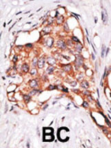 Formalin-fixed and paraffin-embedded human cancer tissue reacted with the primary antibody, which was peroxidase-conjugated to the secondary antibody, followed by DAB staining. This data demonstrates the use of this antibody for immunohistochemistry; clinical relevance has not been evaluated. BC = breast carcinoma; HC = hepatocarcinoma.